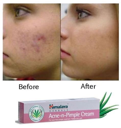 Acne-n-Pimple Cream Himalaya — для лечения высыпаний на коже — Netto