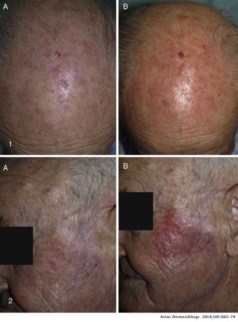 Blue Light Treatment Actinic Keratosis Cost | Americanwarmoms.org