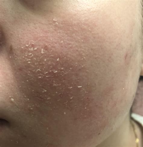 [skin concerns] EXTREME WINDBURN from extreme -30 celsius cold in