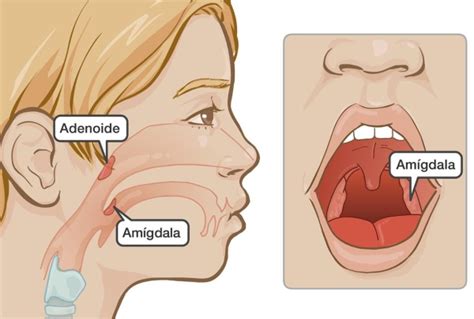 Adenoides E Amigdalas - Nariz De Adenoides CIRURGIA De AMIGDALAS E Adenoides: Dr. Luciano