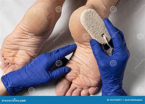Flaky Skin on the Feet. Cracked Heel on Human Foot, Dry, Flaky Skin ...