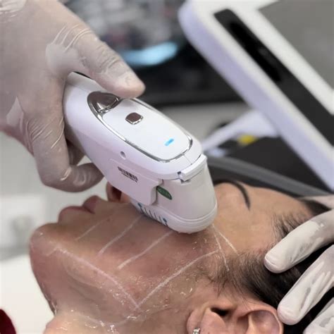 SMAS лифтинг, смас лифтинг цена Киев, процедура smas лифтинг цена в Dr ...