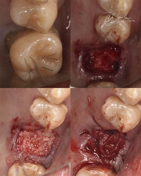 Why Socket Preservation Matters for Dental Implants - Sydney Smile Care