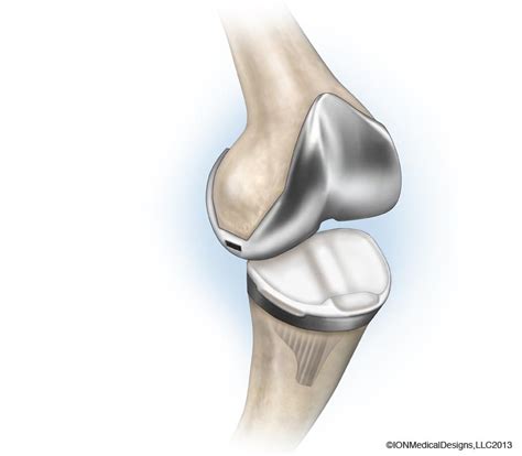 Total Joint Replacement - Joint Preservation Center