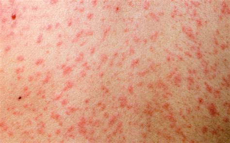 Measles: Clinical review | GPonline