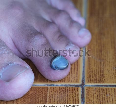 3 Images Black Toe Nail Fungus Images, Stock Photos & Vectors ...