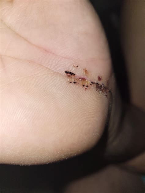 Incision 3 weeks post surgery : r/carpaltunnel