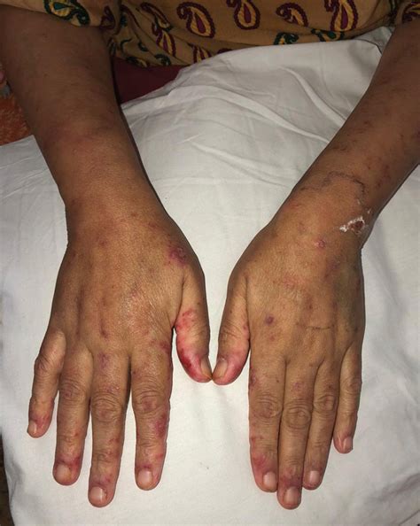 Cutaneous Lupus Face
