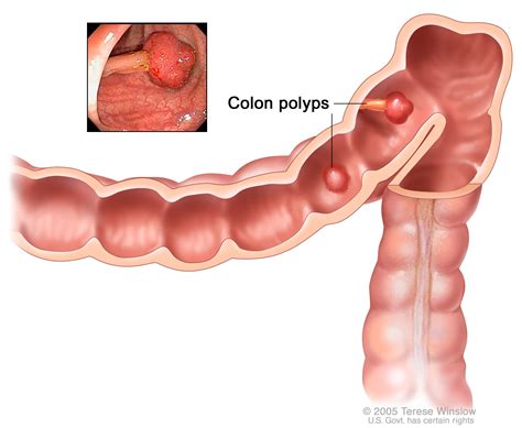 Colorectal Cancer Prevention - NCI