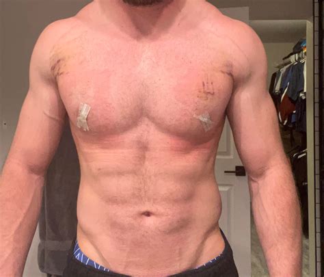 Gyno Surgery Results Dr Blau : r/gynecomastia