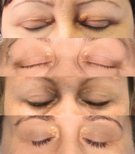 Top 20 Best Xanthelasma Removal Cream Reviews 2025