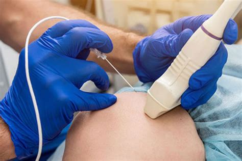 Radiofrequency Nerve Ablation | Innovative Pain Care Center
