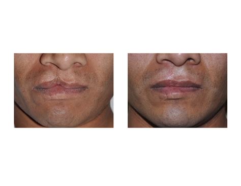 Plastic Surgeon Cleft Lip Repair - Infoupdate.org