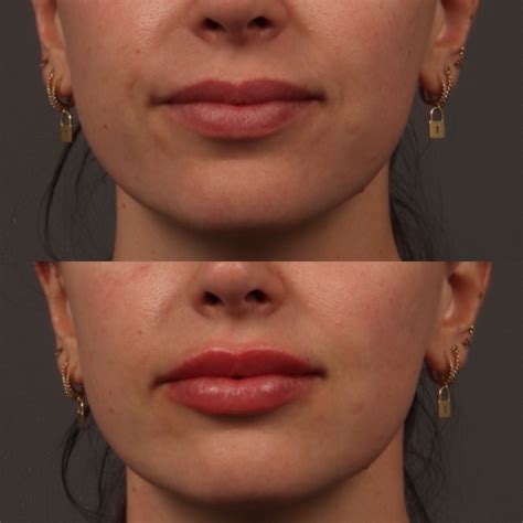 Lip Filler + Cheek Filler + Botox Brow Lift 7 Before & After Photos in