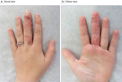 Acrodermatitis - Kamus Istilah Medis | Istilah medis