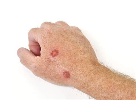 Cryopeeling Is Superior to TCA 35% Peeling in Treatment of Solar