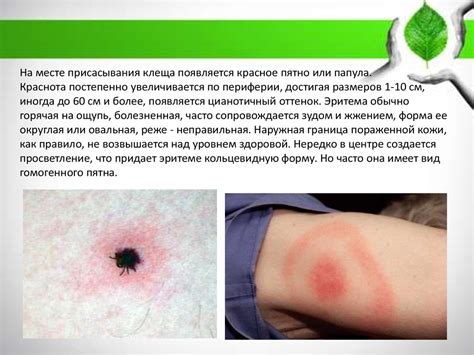 Болезнь Лайма - презентация онлайн