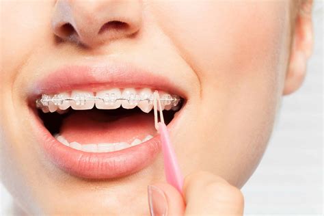 Rubber Bands in Your Mouth: Why You Need to Wear Elastics for Braces