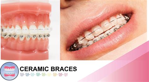 Ceramic Braces in Sydney | OrthoBoutique