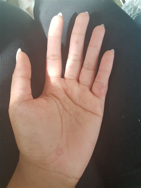Hand Foot Mouth Disease In Adults at Josiah Perez blog