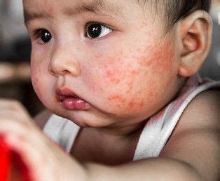 kenali ruam merah  wajah  kecil klikdokter