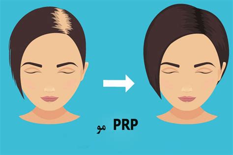 پی آر پی مو | دکتر گیتا مجیدزاده
