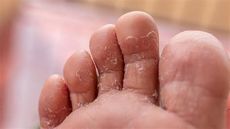 gatal  kutu air simak dibawah  sukoharjonewscom