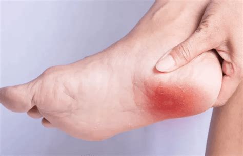 How to cure plantar fasciitis forum