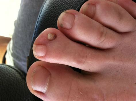 discovered  friend   toenails   toe toe