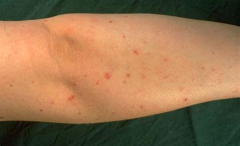 Sarcoptes scabiei in Cats (Felis) | Vetlexicon