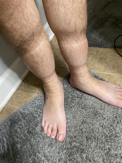 Why are my legs so bloated? I’m 6’2 and barely 160lbs… a little worried