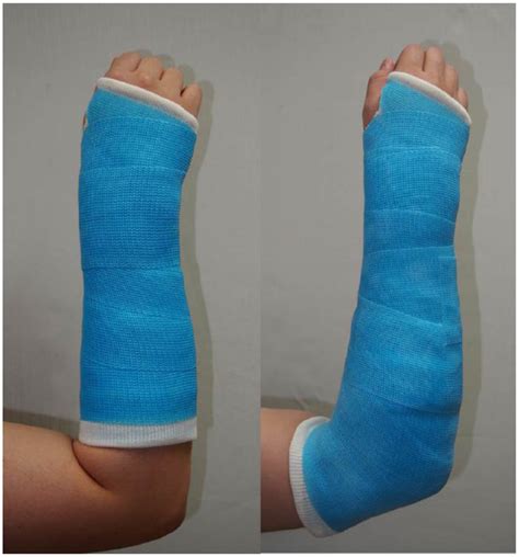 Distal Radius Fracture Splint UK Pre | ids-deutschland.de