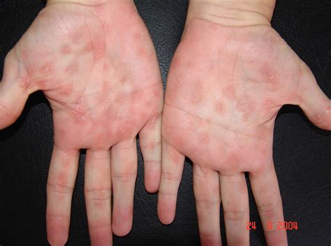 Syphilis stages, signs, symptoms, diagnosis, treatment and syphilis cure