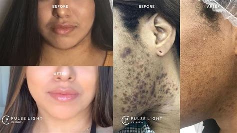 pcos face study reveals significant productivity loss due  pcos