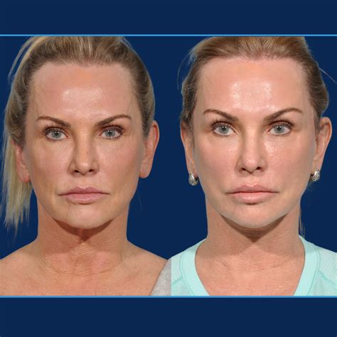 demystifying  deep plane facelift smas lift dr john burns dr
