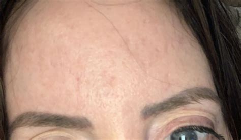 Forehead acne scars - Scar treatments - Acne.org