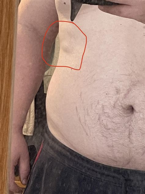 Lump on hamstring : r/Lipoma