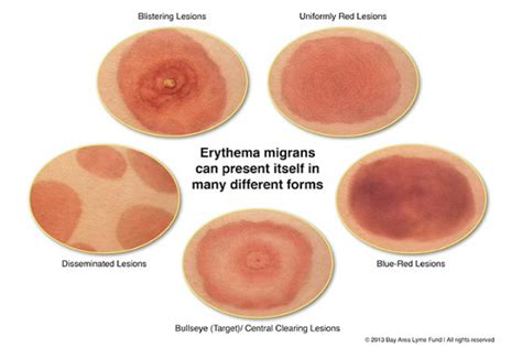 Defend Against Lyme Disease: Tick Treatments for Yard