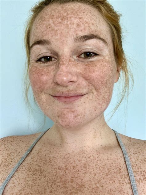tons  freckles