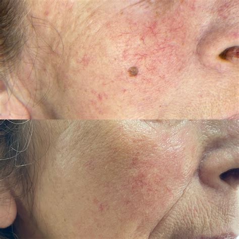 This tiny seborrhoea was... - Transition Permanent Cosmetics