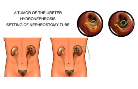 Complete Guide to Nephrostomy Tube Care | Kidney Health | Post-Surgical ...