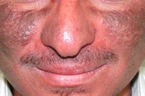 Меланозы лица (facial melanoses)
