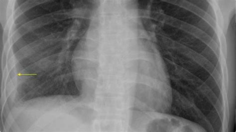 Thorax | 8.2 Pleural space : Case 8.2.2 Benign and malignant pleural ...