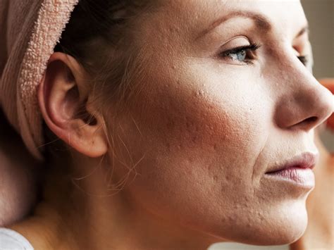 Top 6 Triggers of Acne Rosacea – Balmonds