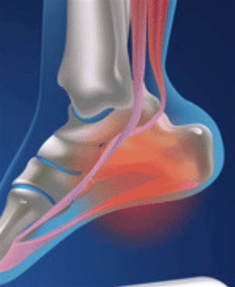 Foot Pain - Understanding plantar Fasciopathy (Plantar Fasciitis ...