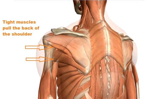 Pulled Shoulder Muscle Injury Chiropractic Care - Wellness Doctor Rx