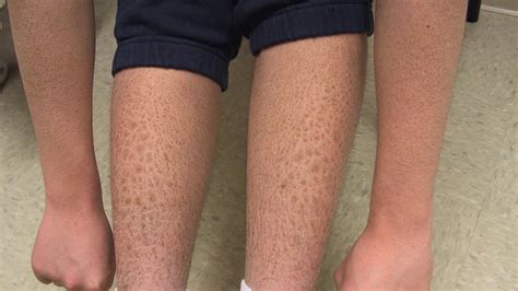 Ichthyosis Vulgaris: Causes, Symptoms, and Diagnosis