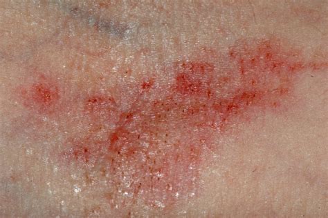 O Que Causa Micose Na Virilha - Imagens De Micose Na Virilha - BRAINCP