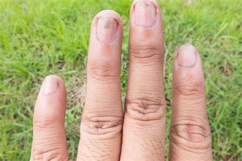 Cómo tratar hongos en las uñas efectivamente