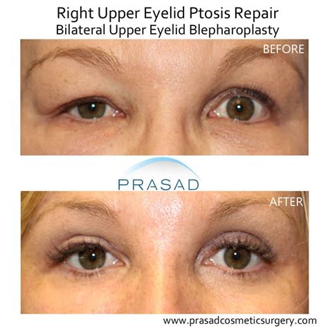 Droopy Eyelid Surgery: Eyelid Ptosis Procedure, and Recovery